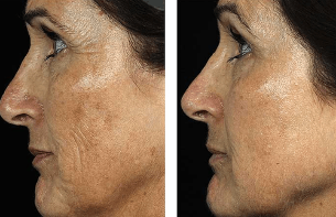 Pred in po delnem pomlajevanju obraza