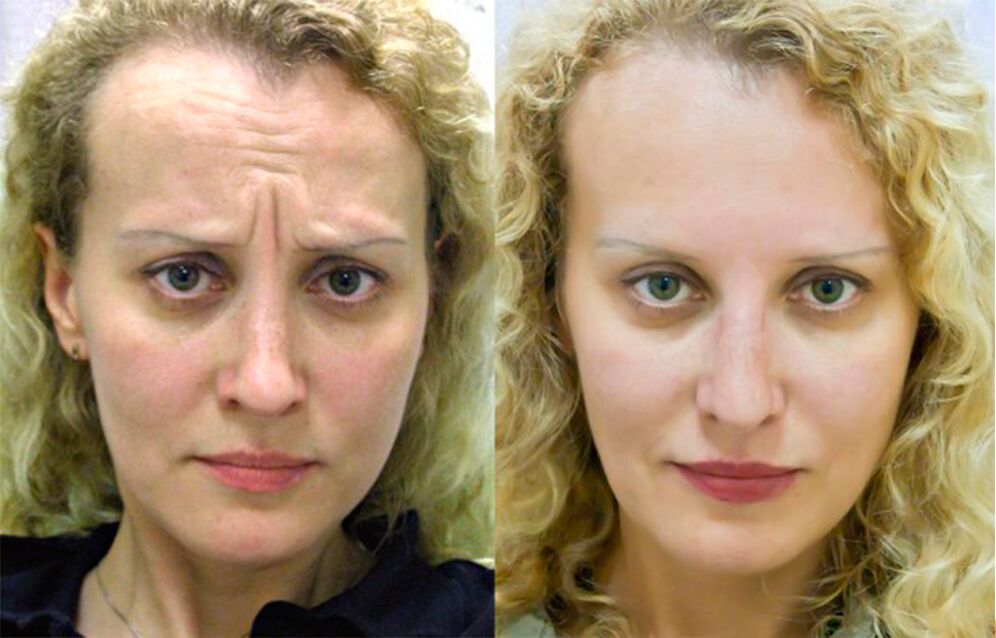 pred in po uporabi masažerja za pomlajevanje ltza fotografija 1
