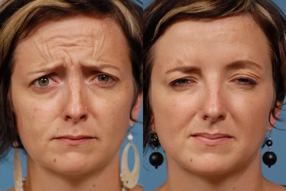 pred in po uporabi masažerja za pomlajevanje ltza fotografija 2