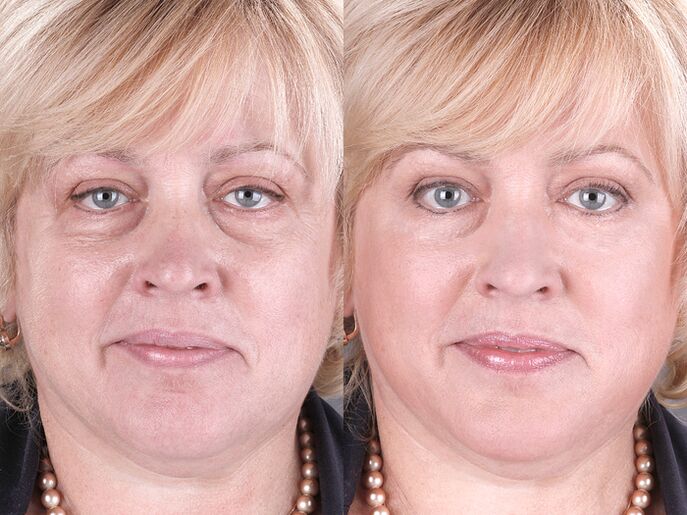 pred in po uporabi masažerja za pomlajevanje ltza fotografija 3