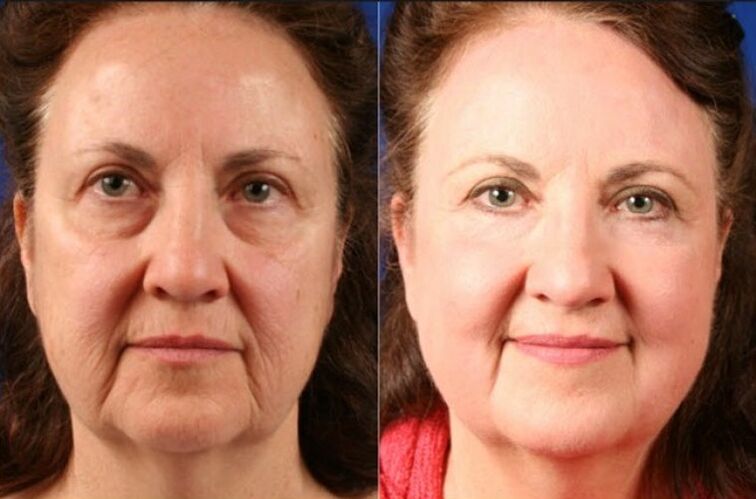 pred in po uporabi masažerja za pomlajevanje ltza fotografija 6