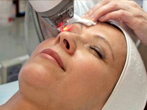 lasersko pomlajevanje kože okoli oči
