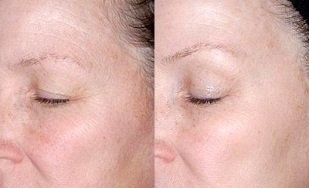 pomlajevanje kože okoli oči pred in po fotografijah