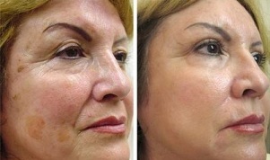 delno pomlajevanje kože pred in po fotografijah