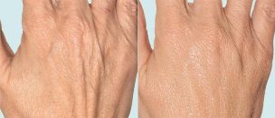 Koža rok pred in po delni terapiji