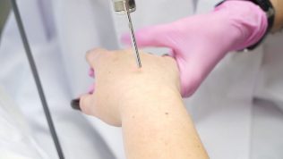 Lasersko pomlajevanje kože rok