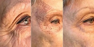 fotografije pred in po pomlajevanju kože v plazmi