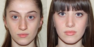 pred in po pomlajevanju kože v plazmi